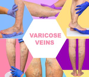 Varicose Veins